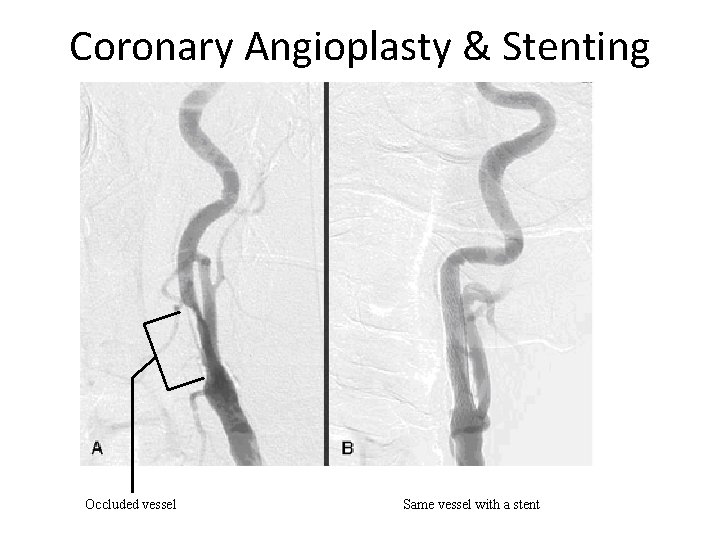 Coronary Angioplasty & Stenting Occluded vessel Same vessel with a stent 