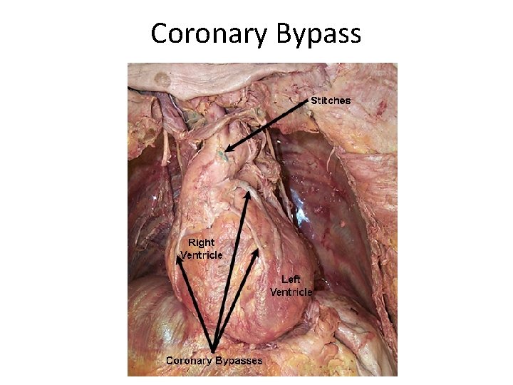 Coronary Bypass Coronary Bypass