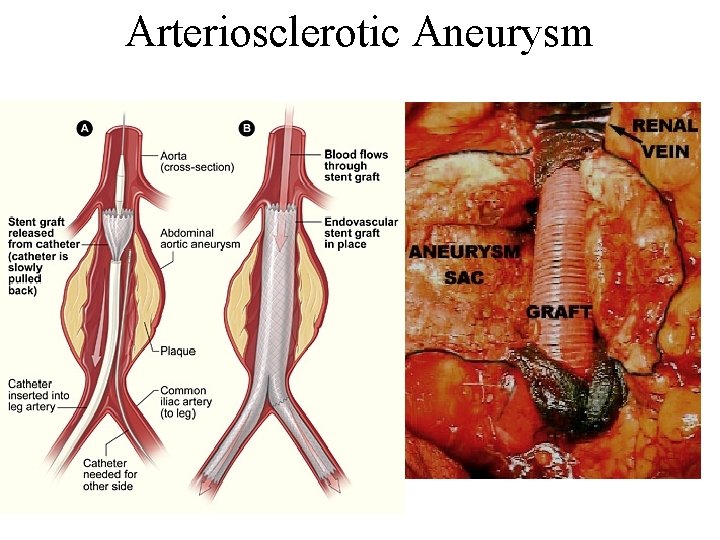 Arteriosclerotic Aneurysm Arteriosclerotic Aneurysm
