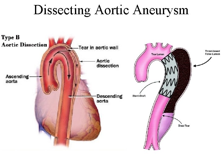Dissecting Aortic Aneurysm 