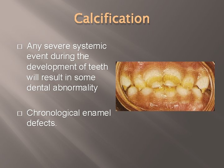 Calcification � Any severe systemic event during the development of teeth will result in