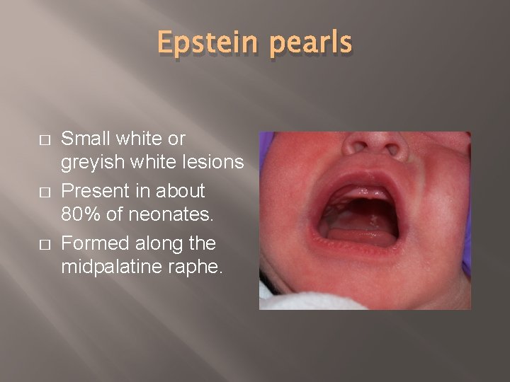 Epstein pearls � � � Small white or greyish white lesions Present in about