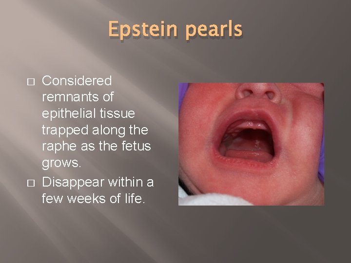 Epstein pearls � � Considered remnants of epithelial tissue trapped along the raphe as