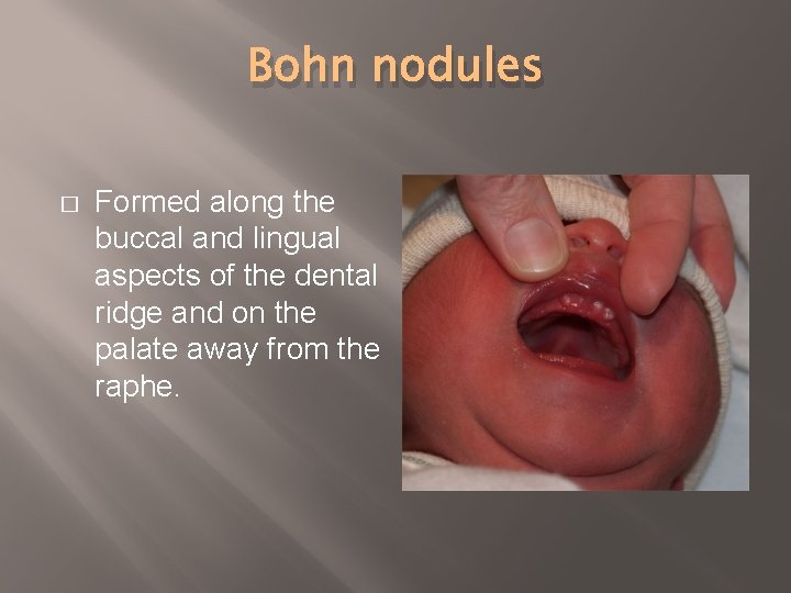 Bohn nodules � Formed along the buccal and lingual aspects of the dental ridge