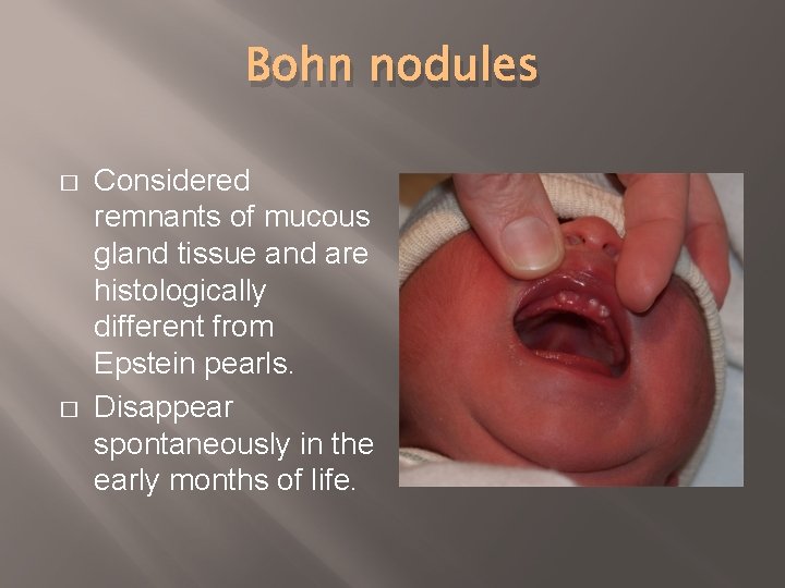 Bohn nodules � � Considered remnants of mucous gland tissue and are histologically different