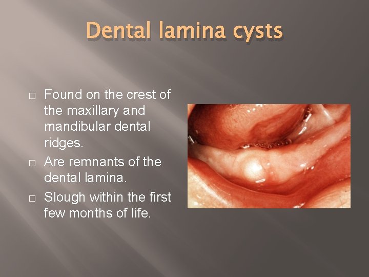 Dental lamina cysts � � � Found on the crest of the maxillary and