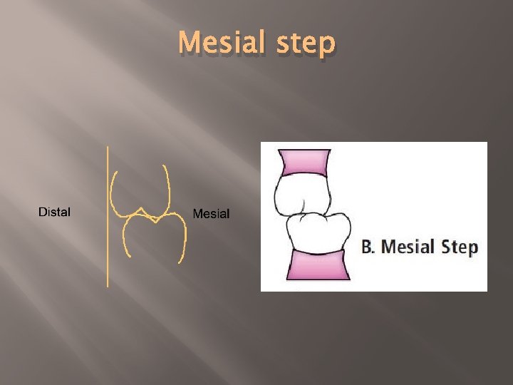 Mesial step 