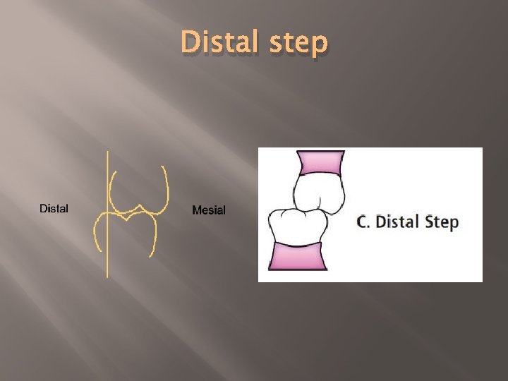 Distal step 