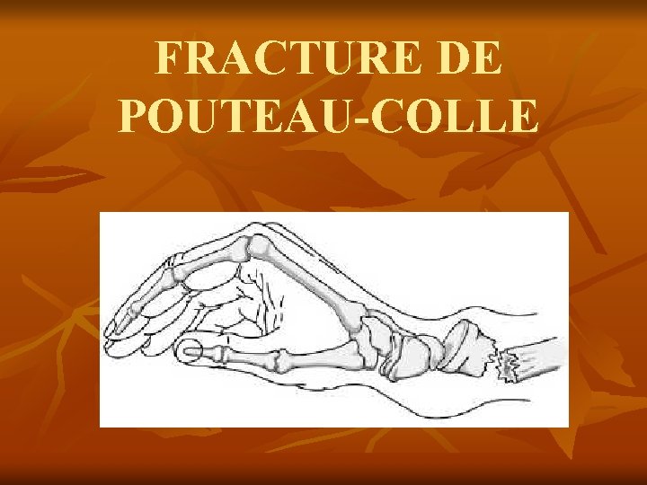 FRACTURE DE POUTEAU-COLLE 
