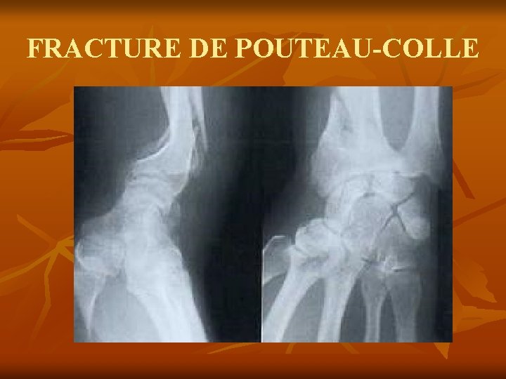 FRACTURE DE POUTEAU-COLLE 