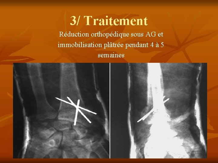 3/ Traitement Réduction orthopédique sous AG et immobilisation plâtrée pendant 4 à 5 semaines