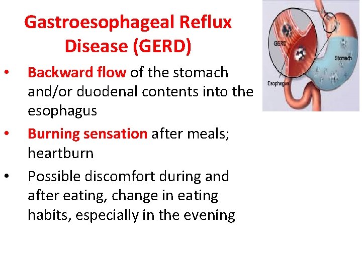 Gastroesophageal Reflux Disease (GERD) • • • Backward flow of the stomach and/or duodenal