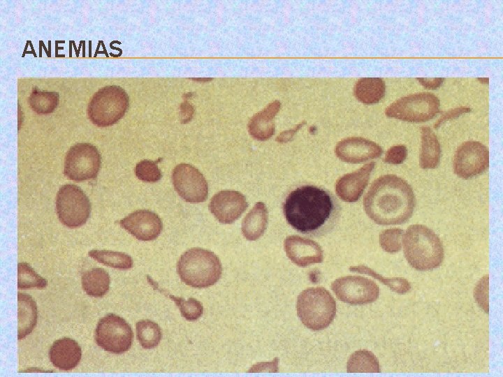 ANEMIAS 