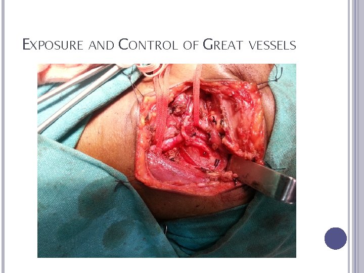 EXPOSURE AND CONTROL OF GREAT VESSELS 