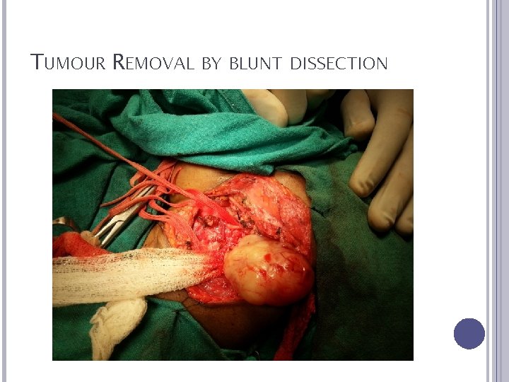 TUMOUR REMOVAL BY BLUNT DISSECTION 