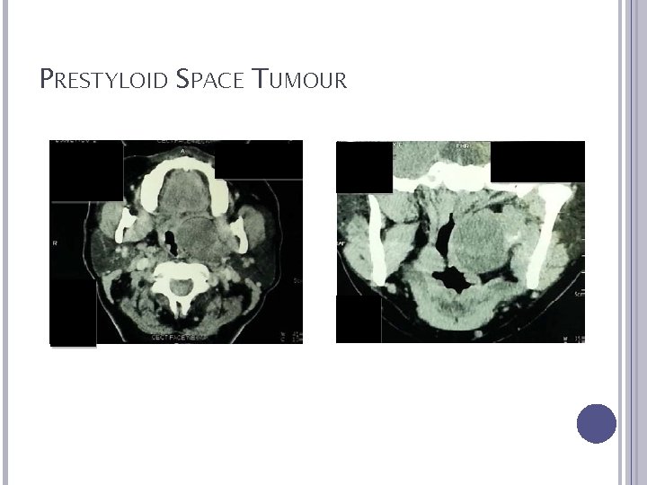 PRESTYLOID SPACE TUMOUR 