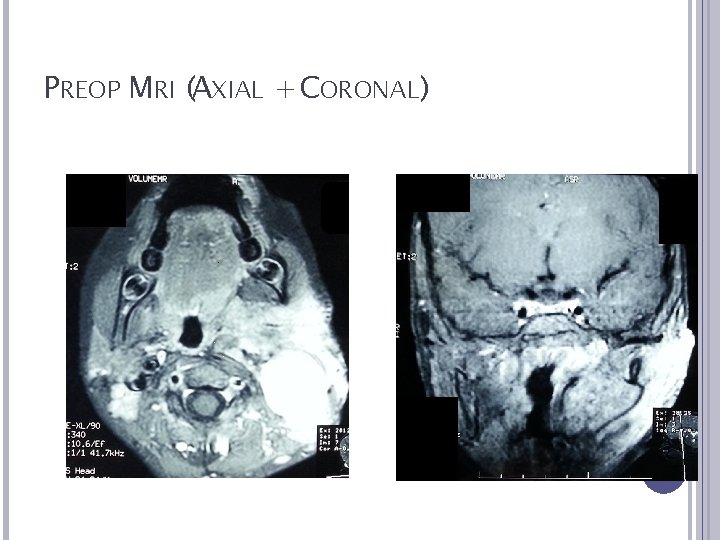 PREOP MRI (AXIAL + CORONAL) 