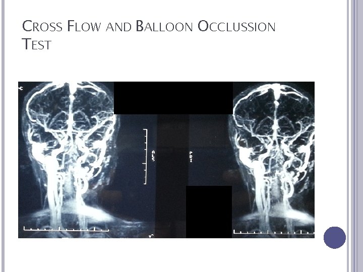 CROSS FLOW AND BALLOON OCCLUSSION TEST 
