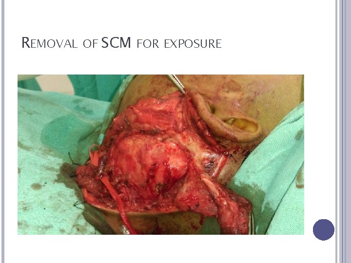 REMOVAL OF SCM FOR EXPOSURE 