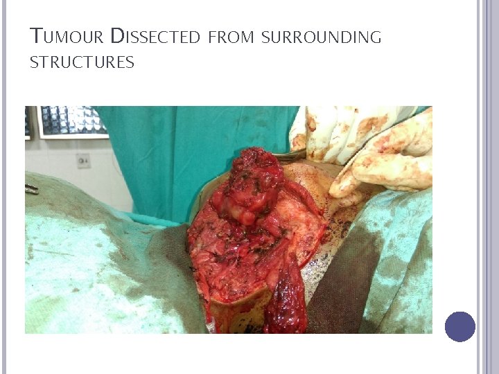 TUMOUR DISSECTED FROM SURROUNDING STRUCTURES 