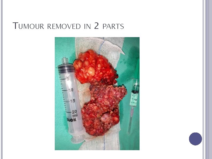 TUMOUR REMOVED IN 2 PARTS 