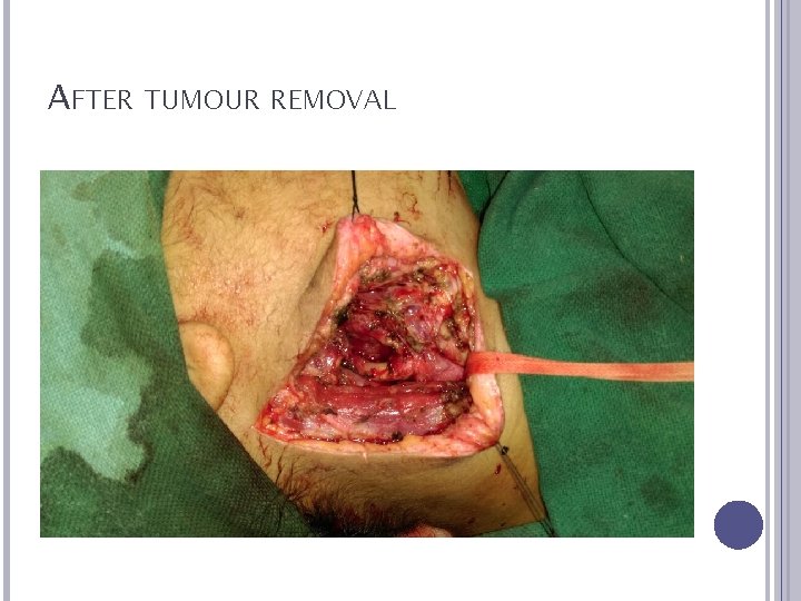 AFTER TUMOUR REMOVAL 