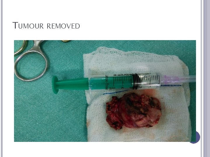 TUMOUR REMOVED 