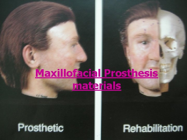 Maxillofacial Prosthesis materials 