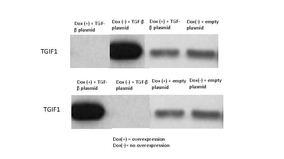 Dox (+) + TGFβ plasmid Dox (-) + TGF-β Dox (+) + TGFβ plasmid Dox (+) + TGFβ plasmid Dox (-) + TGF-β Dox (+) + TGFβ plasmid