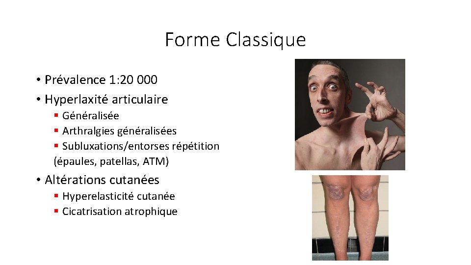 Forme Classique • Prévalence 1: 20 000 • Hyperlaxité articulaire § Généralisée § Arthralgies