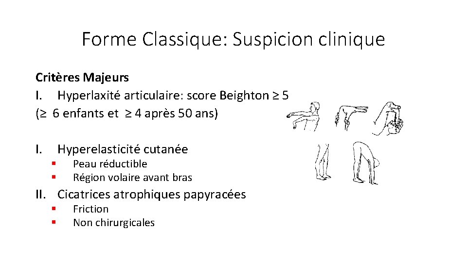 Forme Classique: Suspicion clinique Critères Majeurs I. Hyperlaxité articulaire: score Beighton ≥ 5 (≥