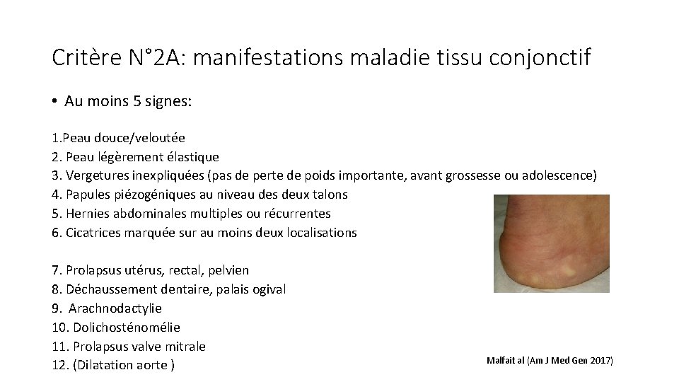 Critère N° 2 A: manifestations maladie tissu conjonctif • Au moins 5 signes: 1.