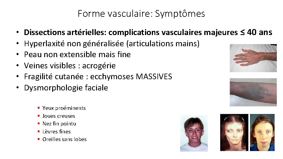 Forme vasculaire: Symptômes • • • Dissections artérielles: complications vasculaires majeures ≤ 40 ans