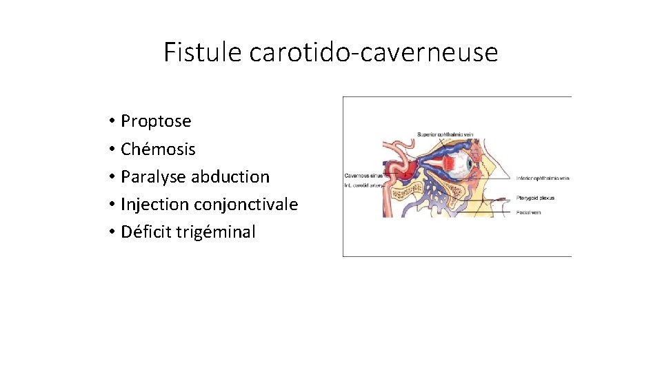 Fistule carotido-caverneuse • Proptose • Chémosis • Paralyse abduction • Injection conjonctivale • Déficit