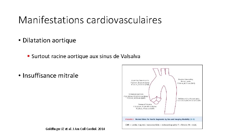 Manifestations cardiovasculaires • Dilatation aortique § Surtout racine aortique aux sinus de Valsalva •