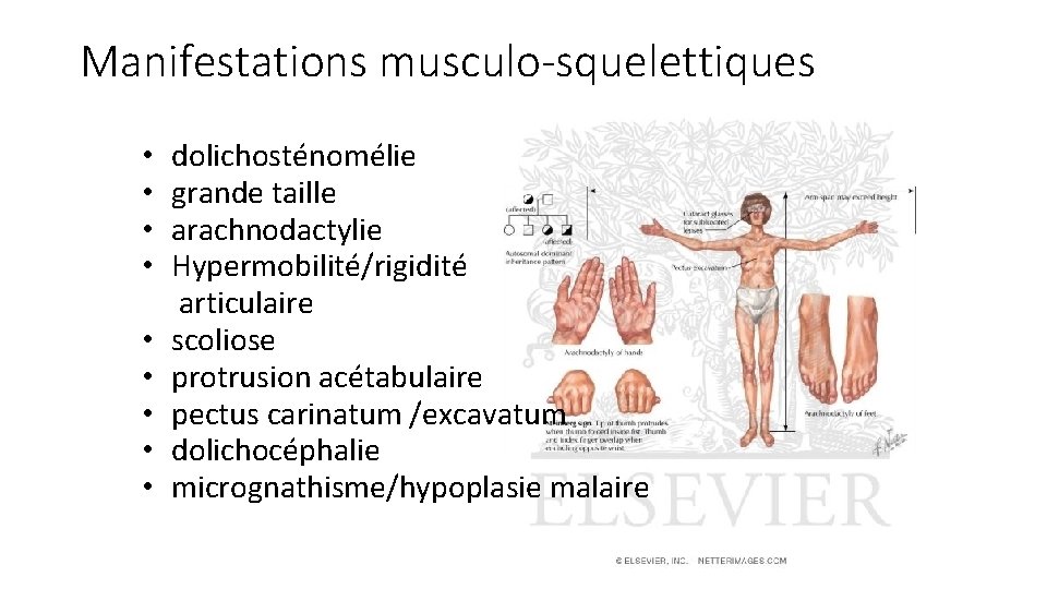 Manifestations musculo-squelettiques • dolichosténomélie • grande taille • arachnodactylie • Hypermobilité/rigidité articulaire • scoliose