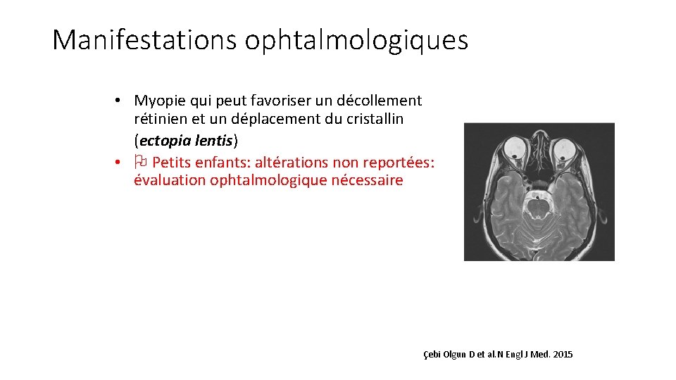 Manifestations ophtalmologiques • Myopie qui peut favoriser un décollement rétinien et un déplacement du