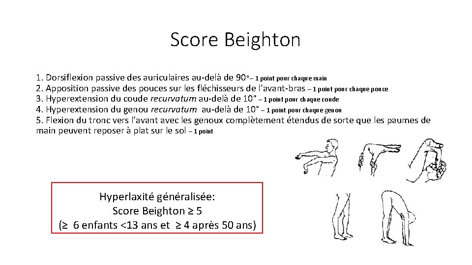Score Beighton 1. Dorsiflexion passive des auriculaires au-delà de 90° – 1 point pour