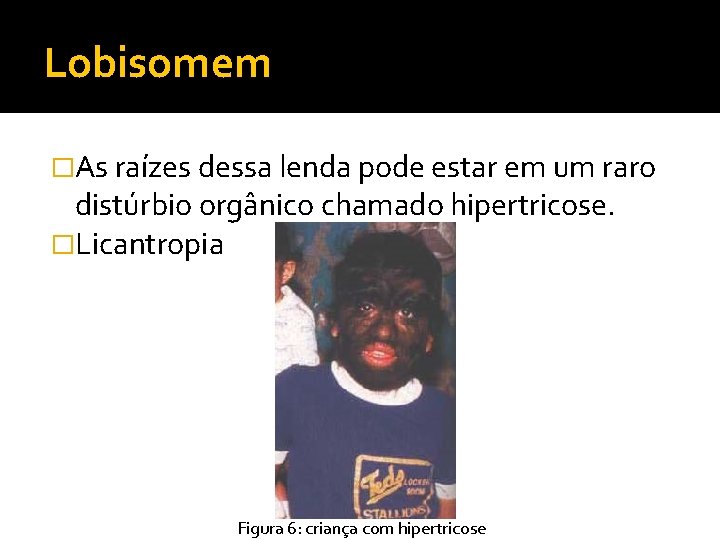 Lobisomem �As raízes dessa lenda pode estar em um raro distúrbio orgânico chamado hipertricose.