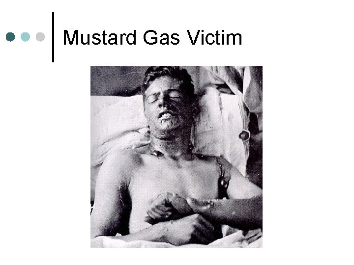 Mustard Gas Victim 