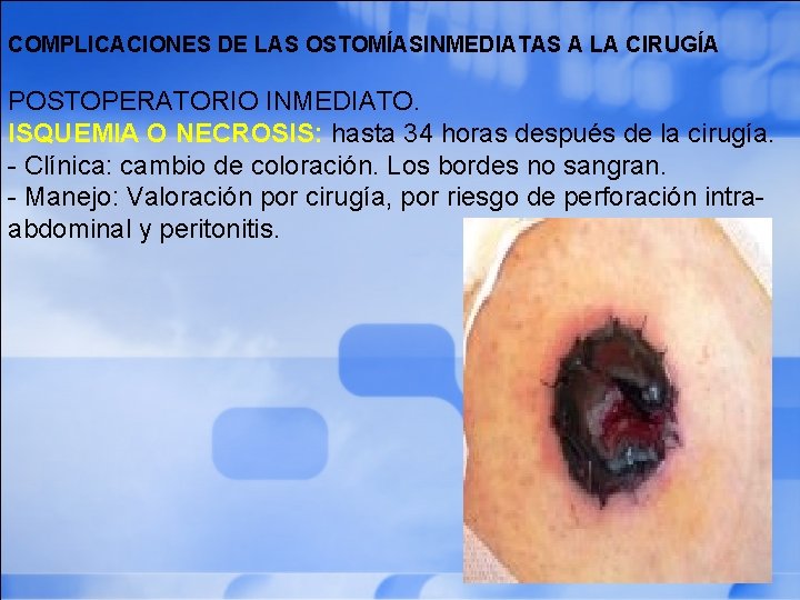 COMPLICACIONES DE LAS OSTOMÍASINMEDIATAS A LA CIRUGÍA POSTOPERATORIO INMEDIATO. ISQUEMIA O NECROSIS: hasta 34