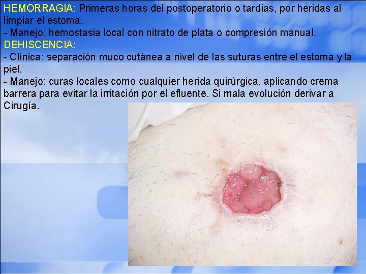 HEMORRAGIA: Primeras horas del postoperatorio o tardías, por heridas al limpiar el estoma. -