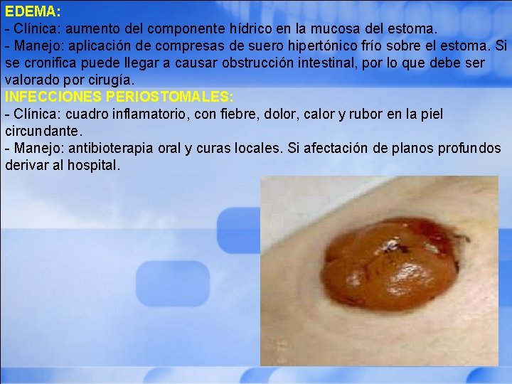 EDEMA: - Clínica: aumento del componente hídrico en la mucosa del estoma. - Manejo: