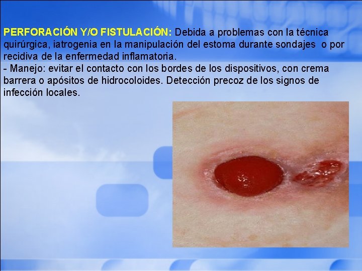 PERFORACIÓN Y/O FISTULACIÓN: Debida a problemas con la técnica quirúrgica, iatrogenia en la manipulación