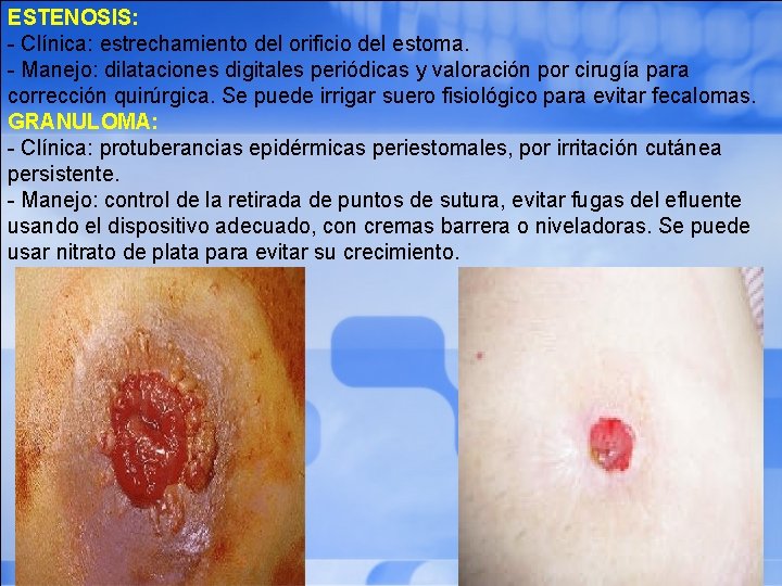 ESTENOSIS: - Clínica: estrechamiento del orificio del estoma. - Manejo: dilataciones digitales periódicas y