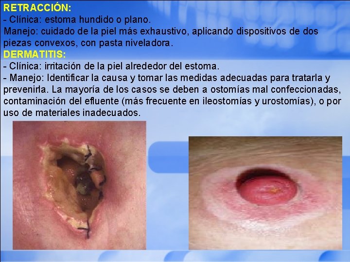 RETRACCIÓN: - Clínica: estoma hundido o plano. Manejo: cuidado de la piel más exhaustivo,