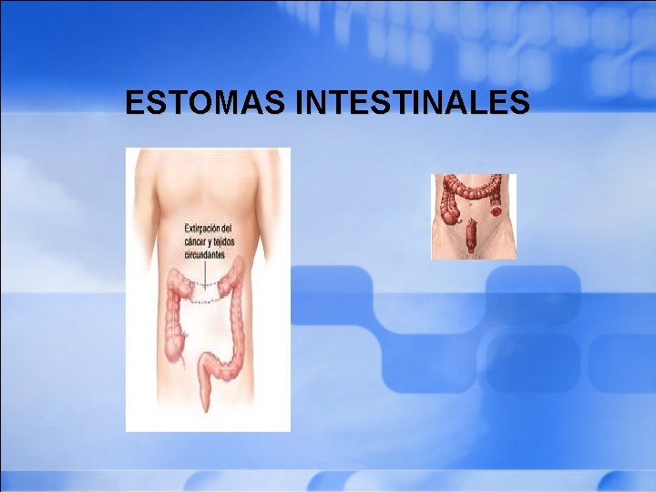 ESTOMAS INTESTINALES 
