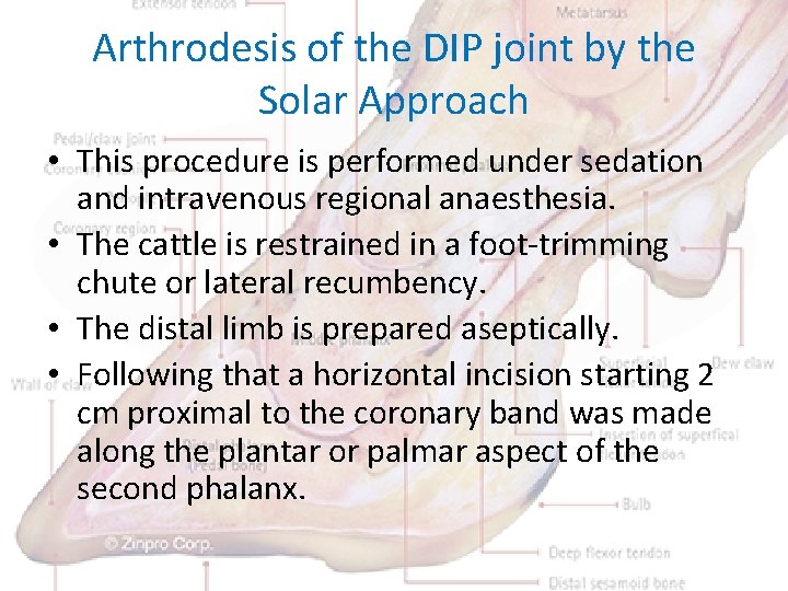 Arthrodesis of the DIP joint by the Solar Approach • This procedure is performed