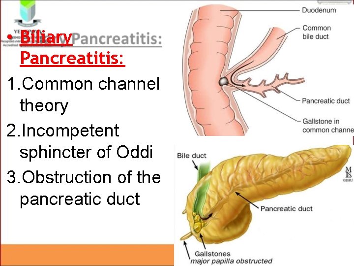 • Biliary Pancreatitis: 1. Common channel theory 2. Incompetent sphincter of Oddi 3. • Biliary Pancreatitis: 1. Common channel theory 2. Incompetent sphincter of Oddi 3.