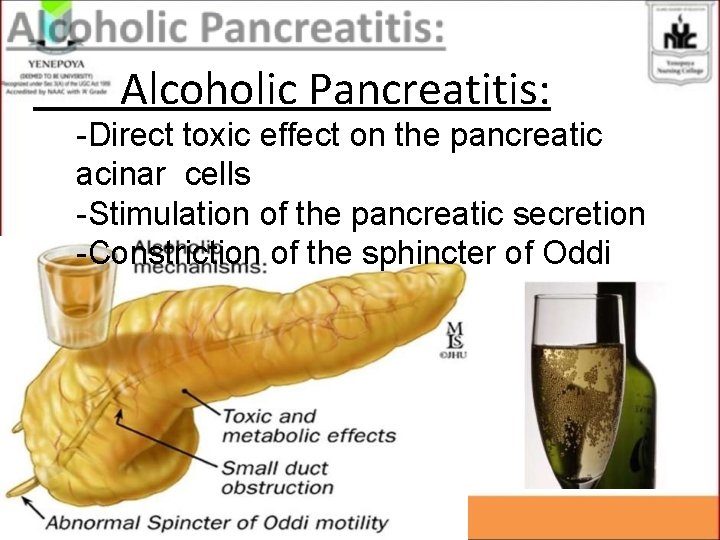 Alcoholic Pancreatitis: -Direct toxic effect on the pancreatic acinar cells -Stimulation of the pancreatic Alcoholic Pancreatitis: -Direct toxic effect on the pancreatic acinar cells -Stimulation of the pancreatic